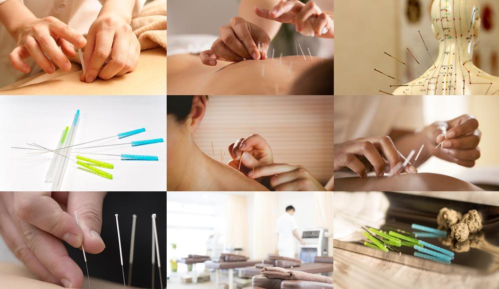 鍼治療